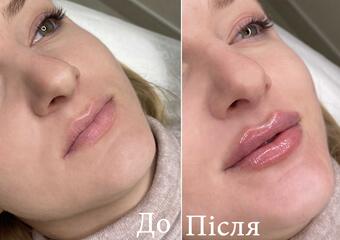 Збільшені губи в Салоні краси Анни Лісовець, Трускавець